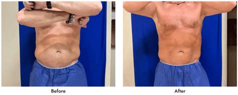 COOLSCULPTING ® FAT REDUCTION IN ST. LOUIS, .